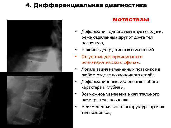 Метастазы в позвоночник прогноз жизни