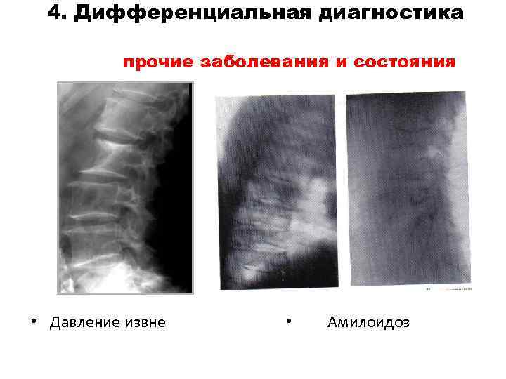 4. Дифференциальная диагностика прочие заболевания и состояния • Давление извне • Амилоидоз 