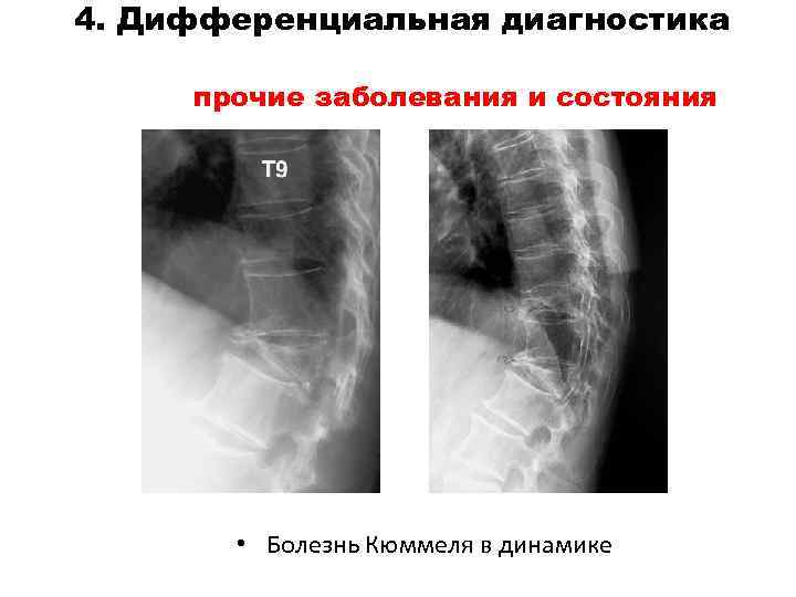 4. Дифференциальная диагностика прочие заболевания и состояния • Болезнь Кюммеля в динамике 