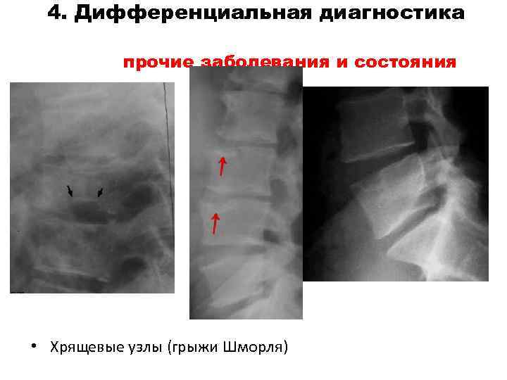 4. Дифференциальная диагностика прочие заболевания и состояния • Хрящевые узлы (грыжи Шморля) 