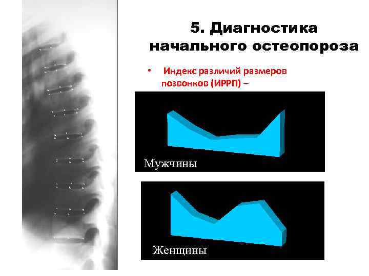 5. Диагностика начального остеопороза • Индекс различий размеров позвонков (ИРРП) – Мужчины Женщины 