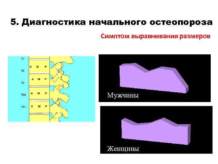 5. Диагностика начального остеопороза Симптом выравнивания размеров Мужчины Женщины 