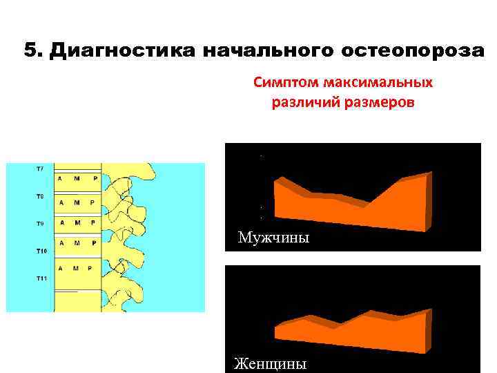 5. Диагностика начального остеопороза Симптом максимальных различий размеров Мужчины Женщины 