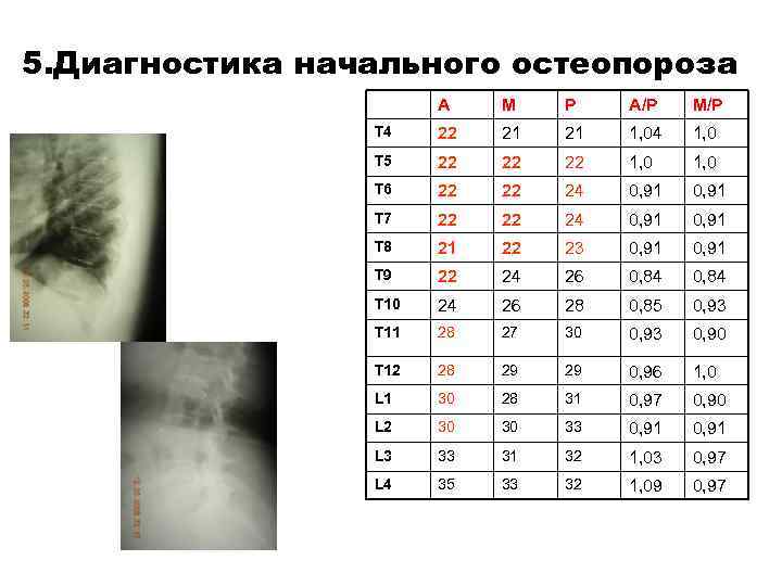 5. Диагностика начального остеопороза А М Р А/Р М/Р Т 4 22 21 21