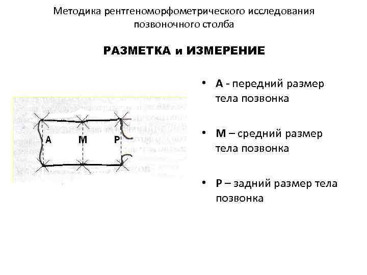 Методика рентгеноморфометрического исследования позвоночного столба РАЗМЕТКА и ИЗМЕРЕНИЕ • А - передний размер тела