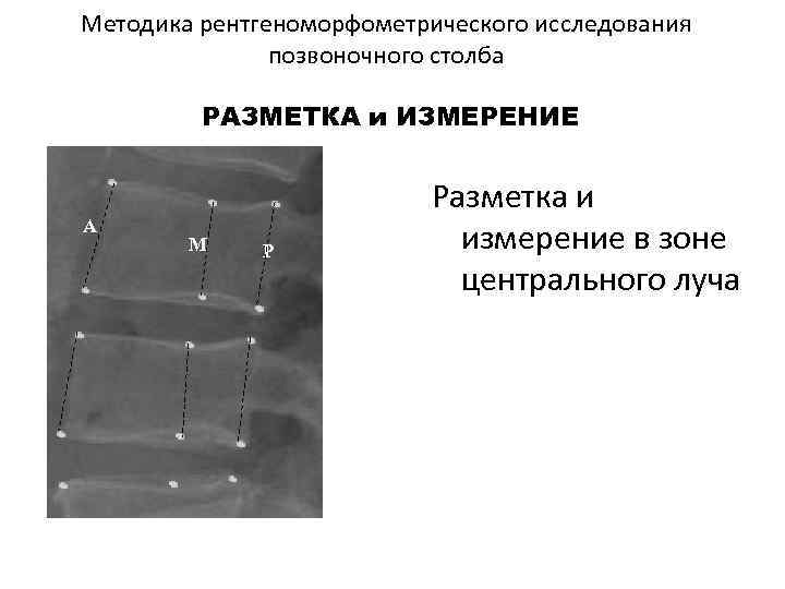 Методика рентгеноморфометрического исследования позвоночного столба РАЗМЕТКА и ИЗМЕРЕНИЕ А М Р Разметка и измерение