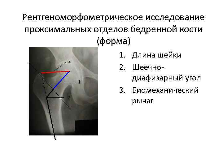 Рентгеноморфометрическое исследование проксимальных отделов бедренной кости (форма) 3 1 2 1. Длина шейки 2.
