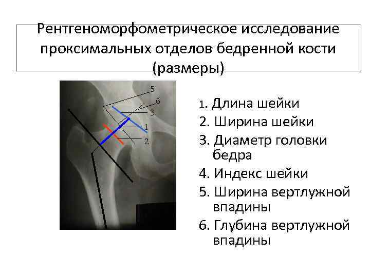 Рентгеноморфометрическое исследование проксимальных отделов бедренной кости (размеры) 5 6 3 . 1. 2 1.