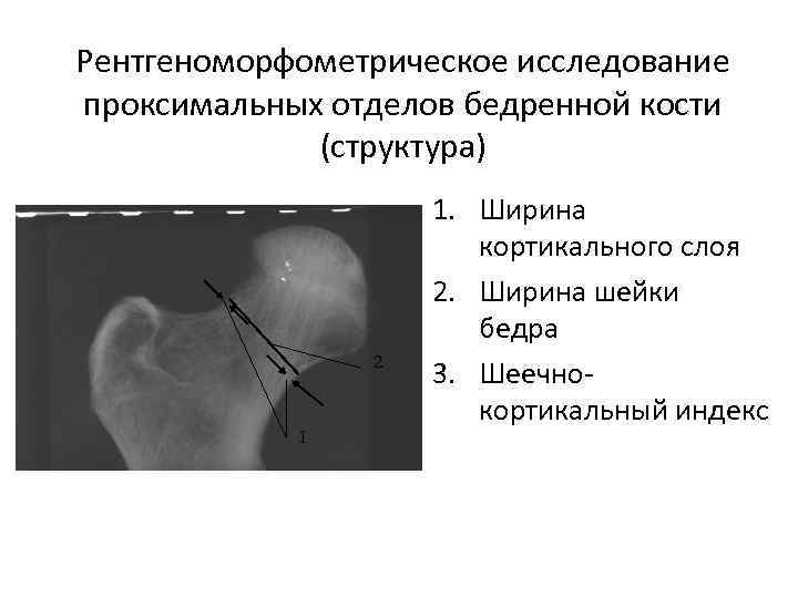 Рентгеноморфометрическое исследование проксимальных отделов бедренной кости (структура) 2 1 1. Ширина кортикального слоя 2.