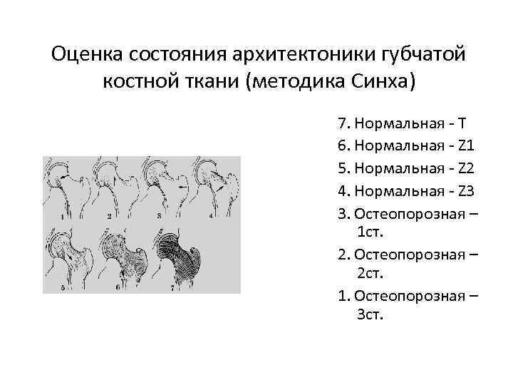 Оценка состояния архитектоники губчатой костной ткани (методика Синха) 7. Нормальная - Т 6. Нормальная