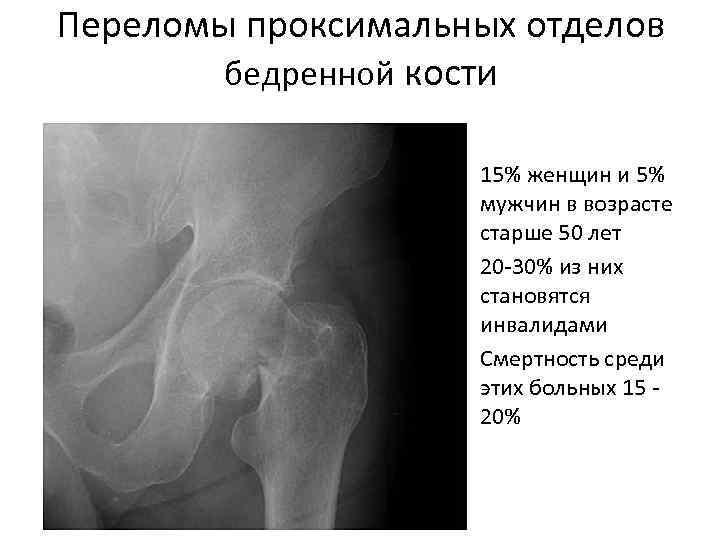 Вертел бедренной кости фото