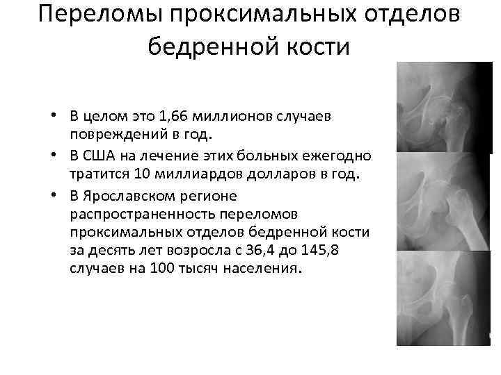 Мкб перелом бедренной. Уровни переломов проксимального отдела бедренной кости. Уровни перелома проксимального отдела бедра. Проксимальный отдел бедренной кости мкб 10.