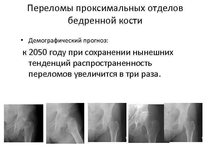 Переломы проксимального отдела бедренной кости презентация