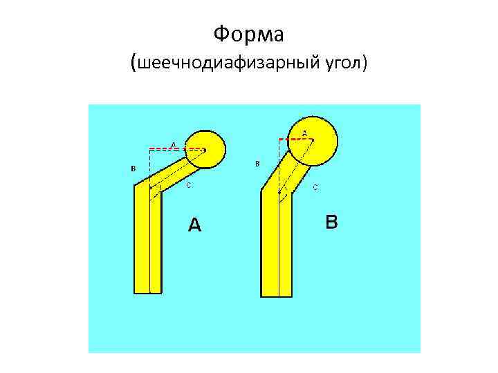 Форма (шеечнодиафизарный угол) 