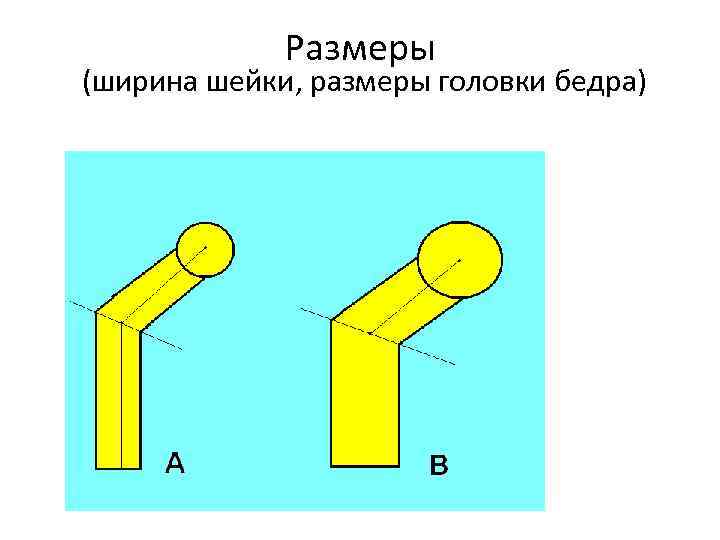 Размеры (ширина шейки, размеры головки бедра) 