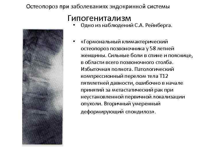 Вторичный остеопороз. Рентгенодиагностика остеопороза. Остеопороз при заболеваниях эндокринной системы.