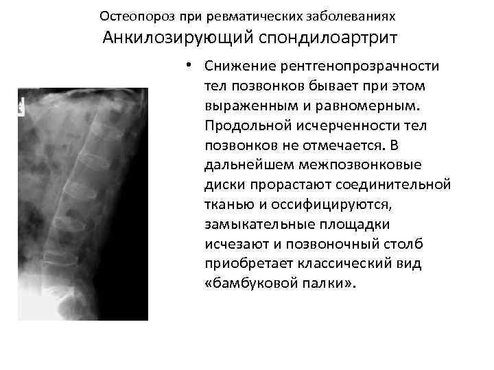 Остеопороз при ревматических заболеваниях Анкилозирующий спондилоартрит • Снижение рентгенопрозрачности тел позвонков бывает при этом