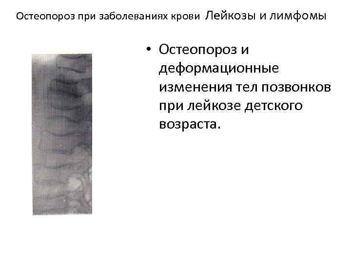 Остеопороз при заболеваниях крови Лейкозы и лимфомы • Остеопороз и деформационные изменения тел позвонков