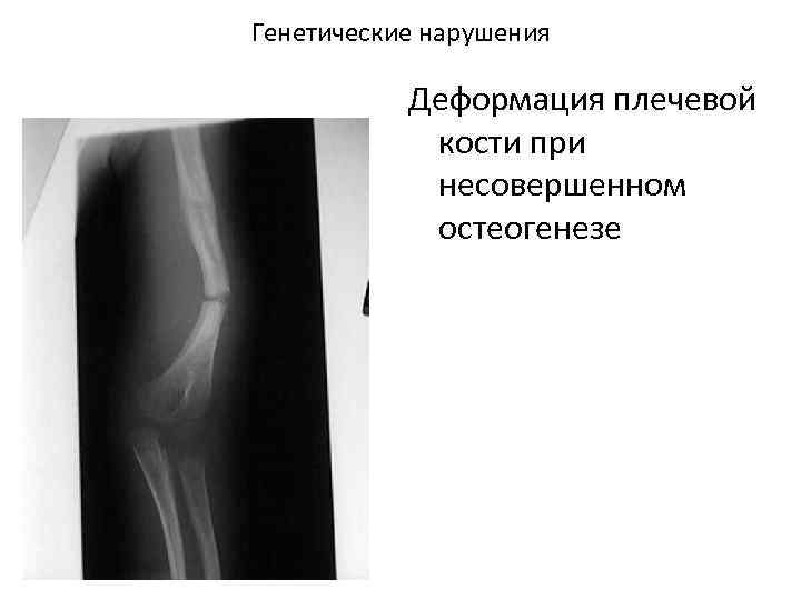 Генетические нарушения Деформация плечевой кости при несовершенном остеогенезе 