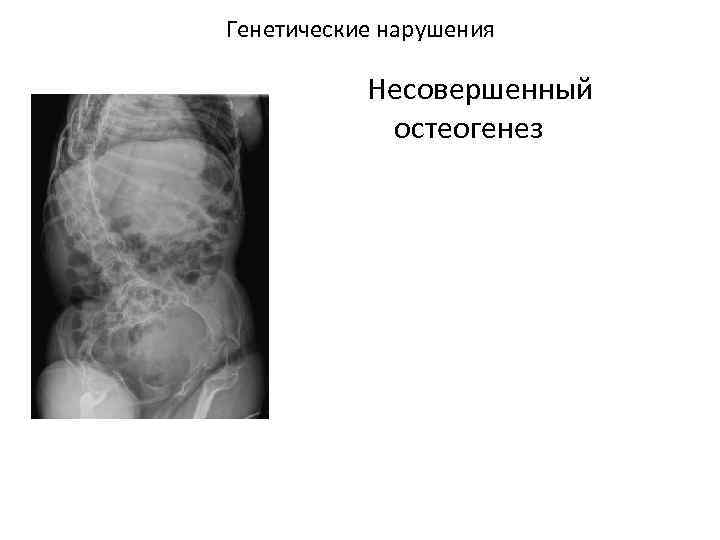 Генетические нарушения Несовершенный остеогенез 