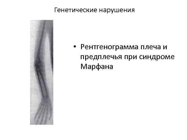 Генетические нарушения • Рентгенограмма плеча и предплечья при синдроме Марфана 