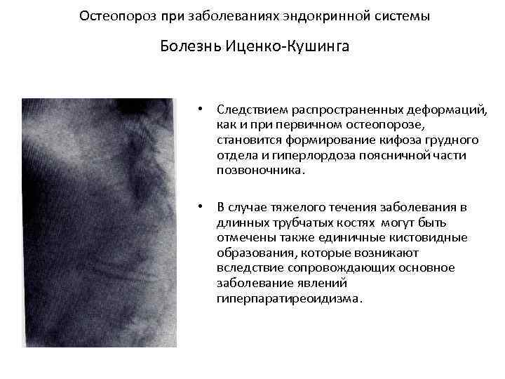 Остеопороз при заболеваниях эндокринной системы Болезнь Иценко-Кушинга • Следствием распространенных деформаций, как и при