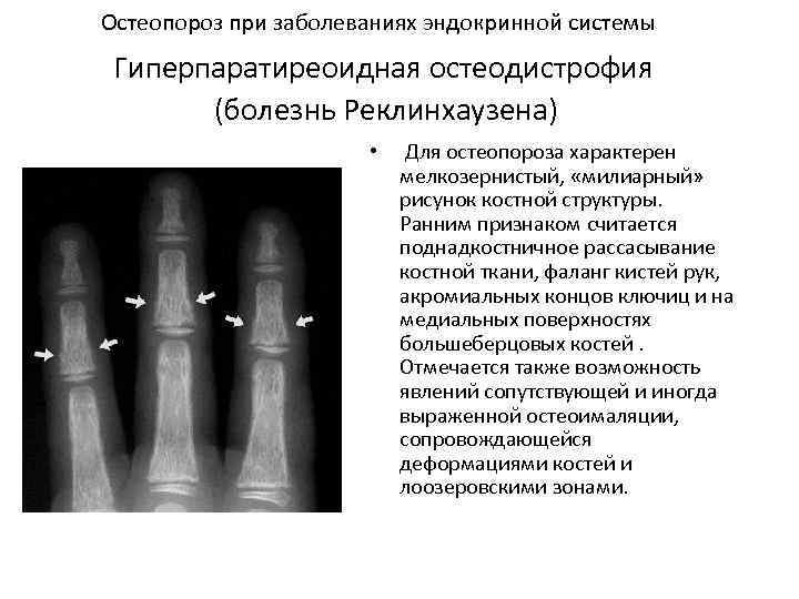 Остеопороз при заболеваниях эндокринной системы Гиперпаратиреоидная остеодистрофия (болезнь Реклинхаузена) • Для остеопороза характерен мелкозернистый,