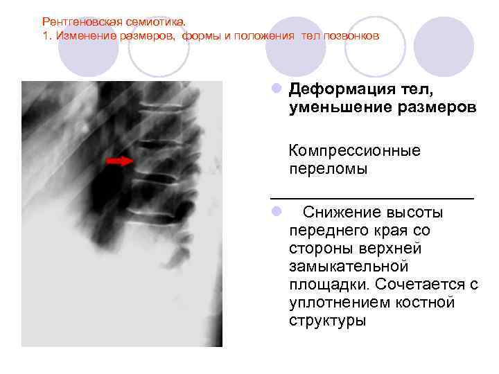 Рентгеновская семиотика. 1. Изменение размеров, формы и положения тел позвонков l Деформация тел, уменьшение