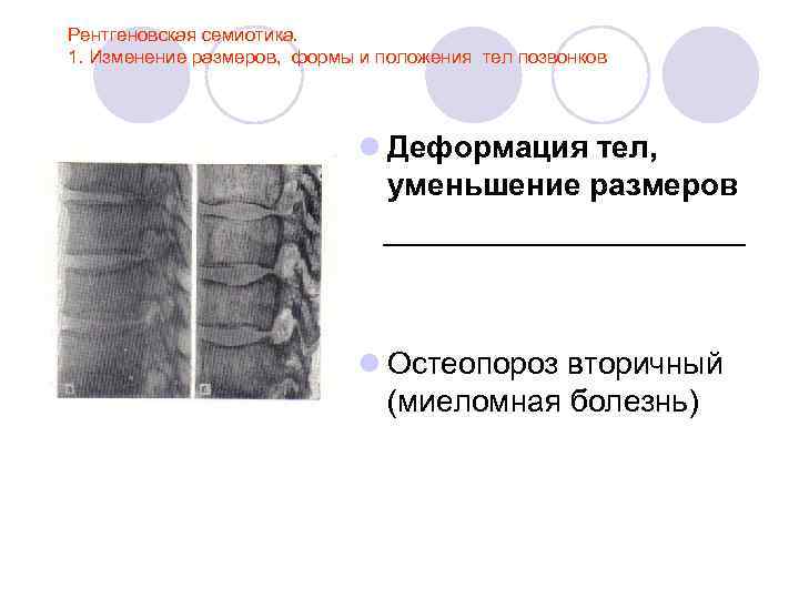 Рентгеновская семиотика. 1. Изменение размеров, формы и положения тел позвонков l Деформация тел, уменьшение