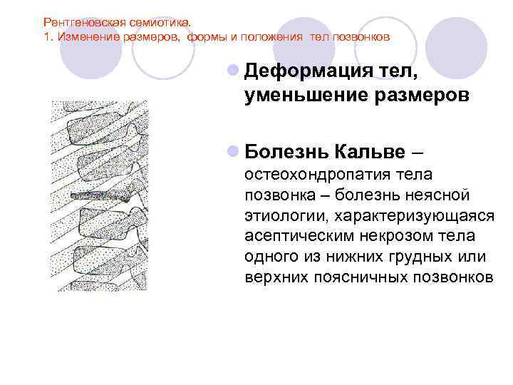 Рентгеновская семиотика. 1. Изменение размеров, формы и положения тел позвонков l Деформация тел, уменьшение