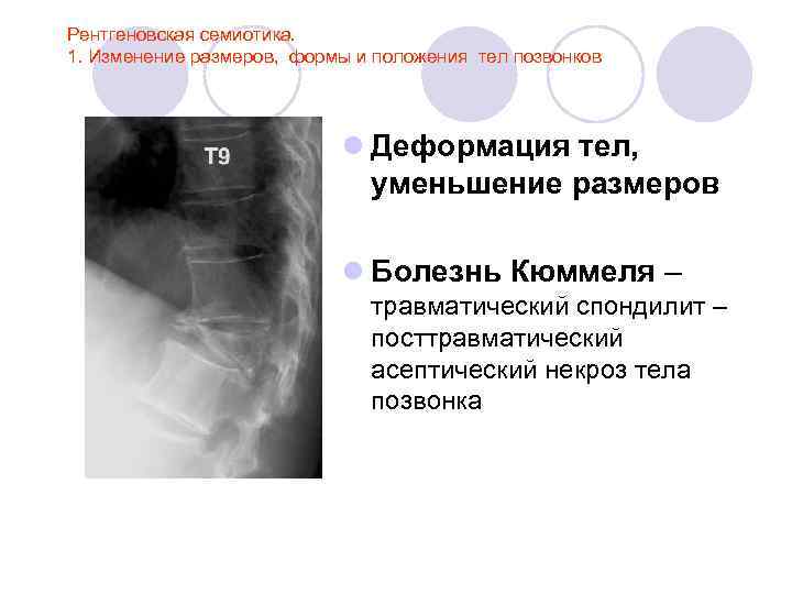 Рентгеновская семиотика. 1. Изменение размеров, формы и положения тел позвонков l Деформация тел, уменьшение