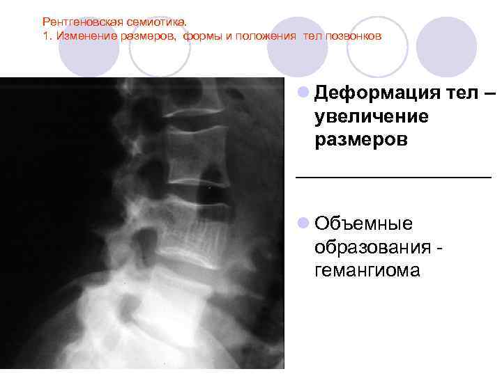 Рентгеновская семиотика. 1. Изменение размеров, формы и положения тел позвонков l Деформация тел –