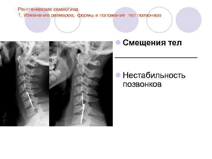 Рентгеновская семиотика. 1. Изменение размеров, формы и положения тел позвонков l Смещения тел _________