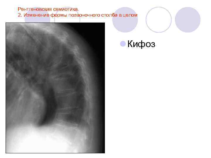 Рентгеновская семиотика. 2. Изменение формы позвоночного столба в целом l Кифоз 