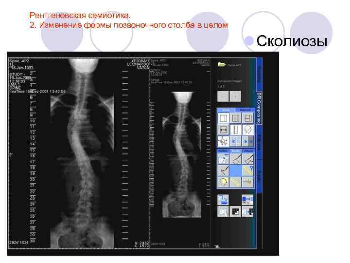 Рентгеновская семиотика. 2. Изменение формы позвоночного столба в целом l Сколиозы 