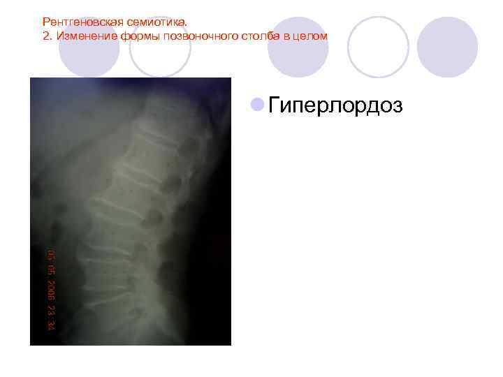 Рентгеновская семиотика. 2. Изменение формы позвоночного столба в целом l Гиперлордоз 