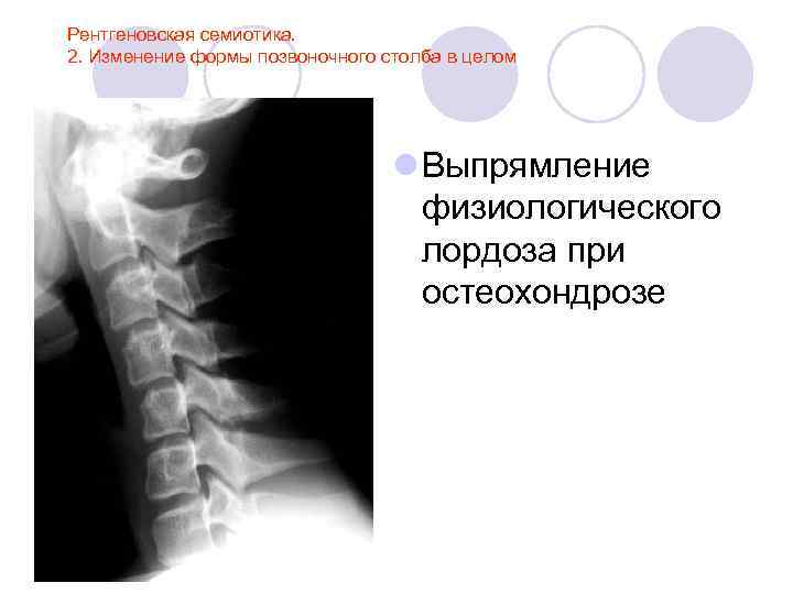 Рентгеновская семиотика. 2. Изменение формы позвоночного столба в целом l Выпрямление физиологического лордоза при