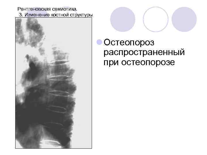 Рентгеновская семиотика. 3. Изменение костной структуры l Остеопороз распространенный при остеопорозе 