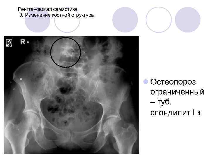 Рентгеновская семиотика. 3. Изменение костной структуры l Остеопороз ограниченный – туб. спондилит L 4