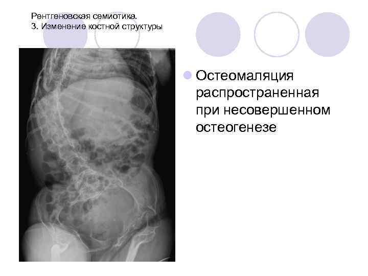 Рентгеновская семиотика. 3. Изменение костной структуры l Остеомаляция распространенная при несовершенном остеогенезе 