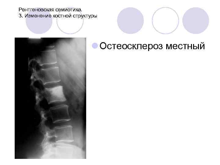 Рентгеновская семиотика. 3. Изменение костной структуры l Остеосклероз местный 