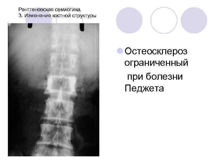 Рентгеновская семиотика. 3. Изменение костной структуры l Остеосклероз ограниченный при болезни Педжета 