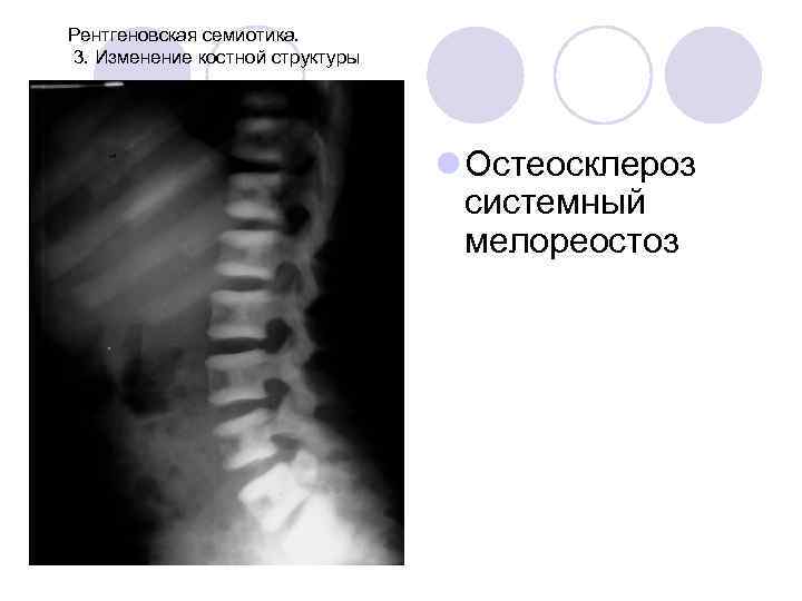 Рентгеновская семиотика. 3. Изменение костной структуры l Остеосклероз системный мелореостоз 