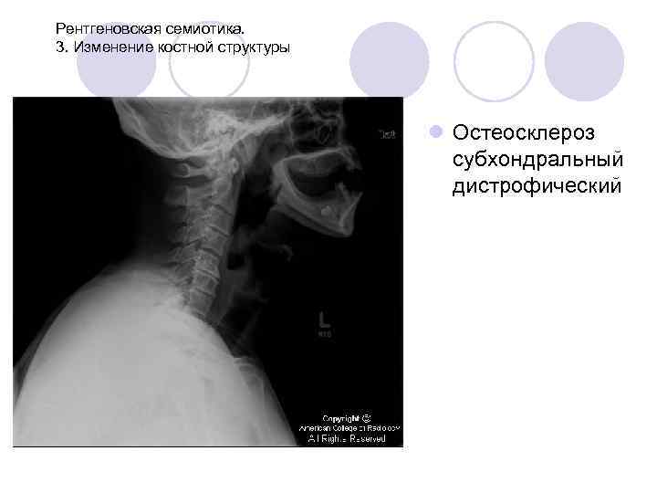 Рентгеновская семиотика. 3. Изменение костной структуры l Остеосклероз субхондральный дистрофический 