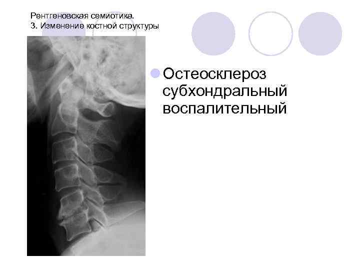 Рентгеновская семиотика. 3. Изменение костной структуры l Остеосклероз субхондральный воспалительный 