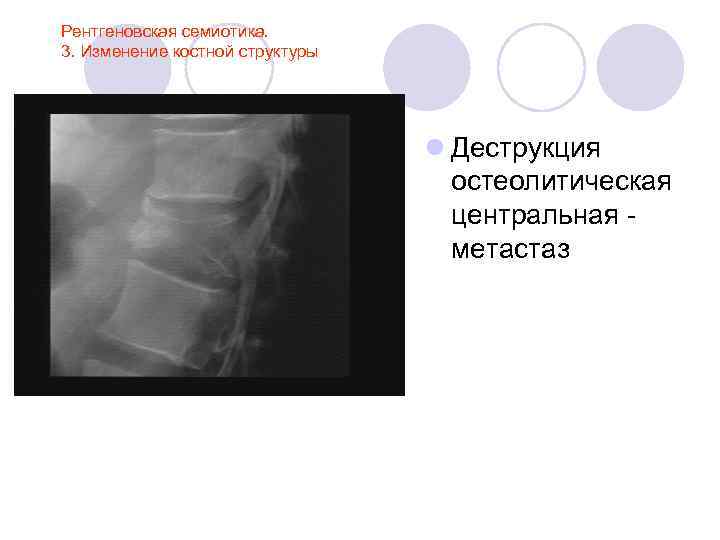 Рентгеновская семиотика. 3. Изменение костной структуры l Деструкция остеолитическая центральная метастаз 