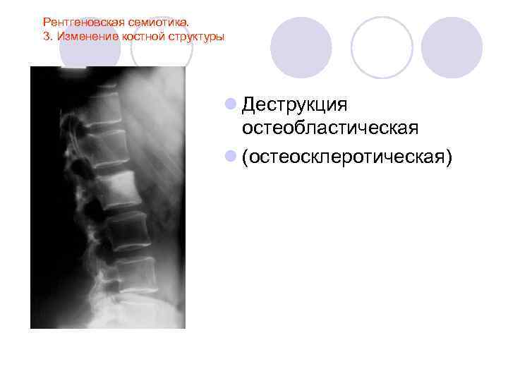 Рентгеновская семиотика. 3. Изменение костной структуры l Деструкция остеобластическая l (остеосклеротическая) 