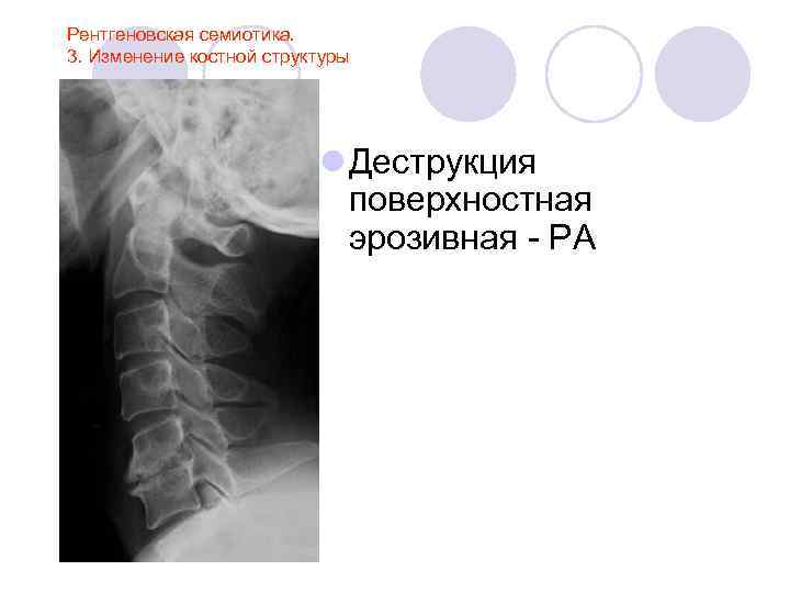 Рентгеновская семиотика. 3. Изменение костной структуры l Деструкция поверхностная эрозивная - РА 