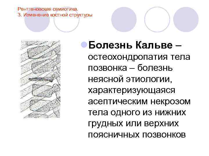 Рентгеновская семиотика. 3. Изменение костной структуры l. Болезнь Кальве – остеохондропатия тела позвонка –