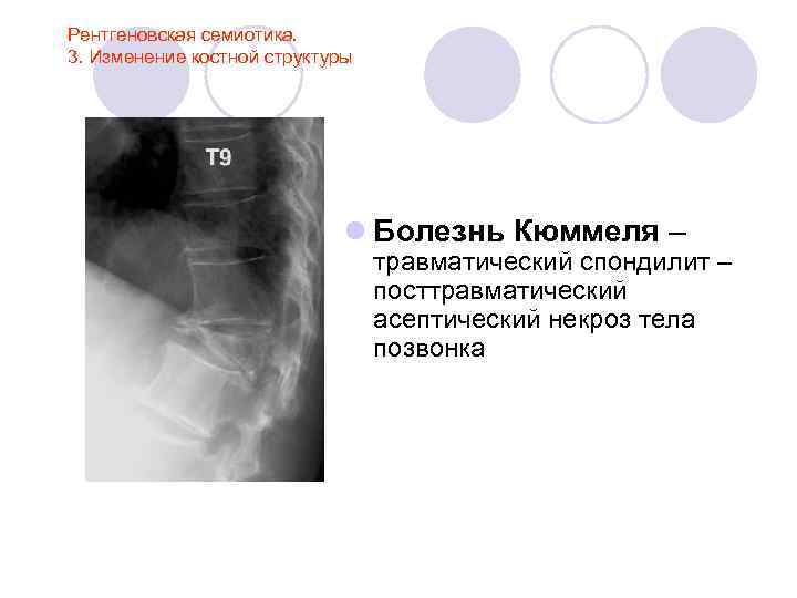 Рентгеновская семиотика. 3. Изменение костной структуры l Болезнь Кюммеля – травматический спондилит – посттравматический